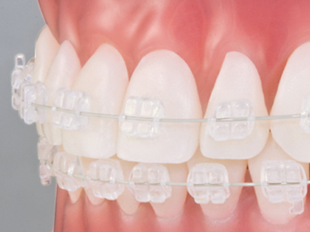 AparatDentarCeramic.jpg